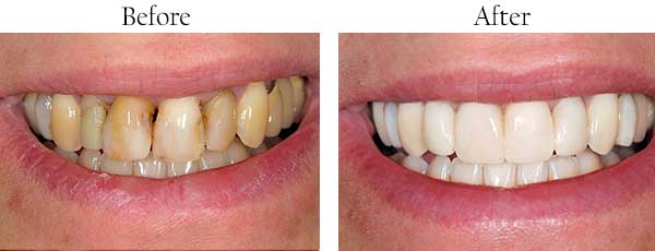 Long Beach Before and After Dental Implants